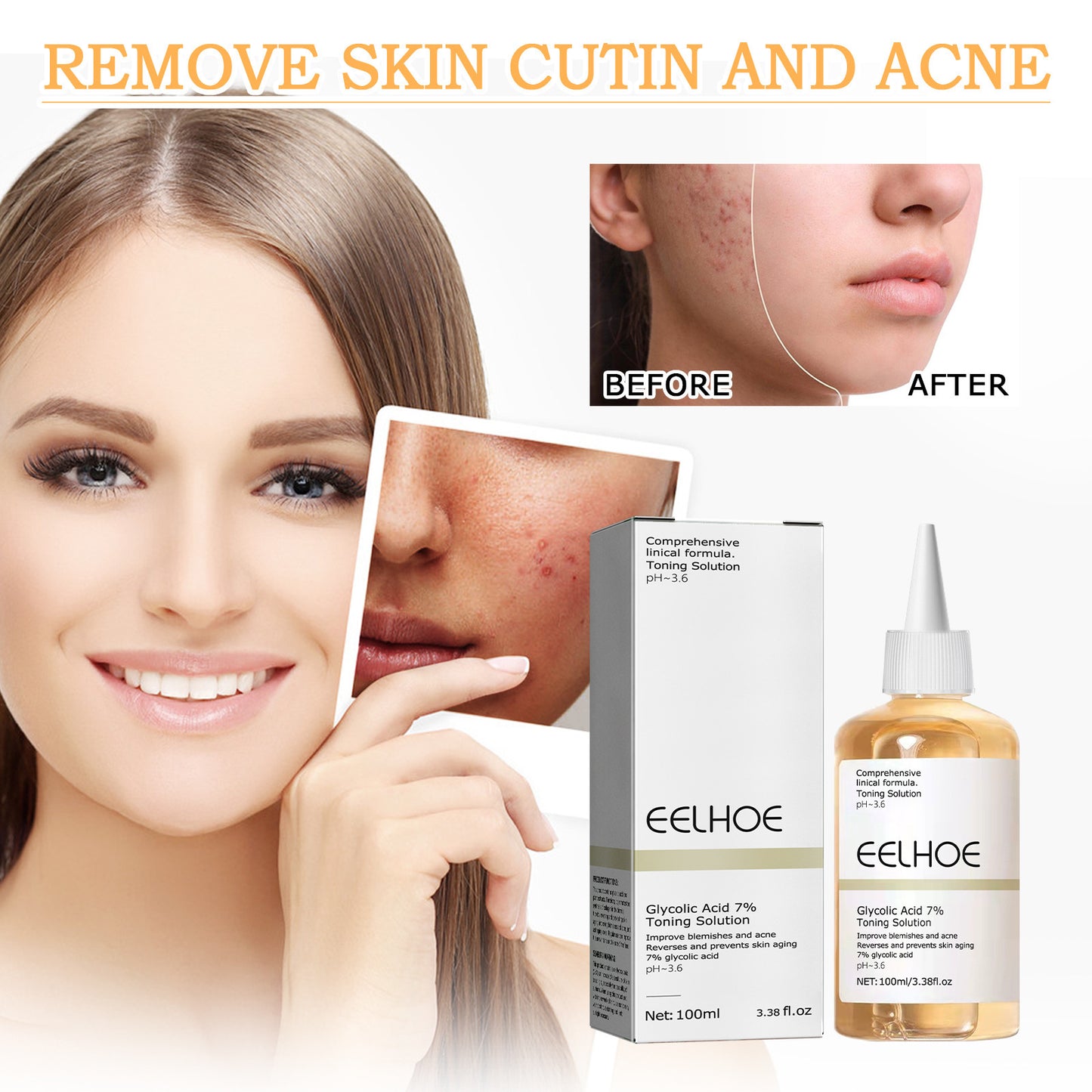 Glycolic Acid 7 Lotion Acne Removing Closed Mouth